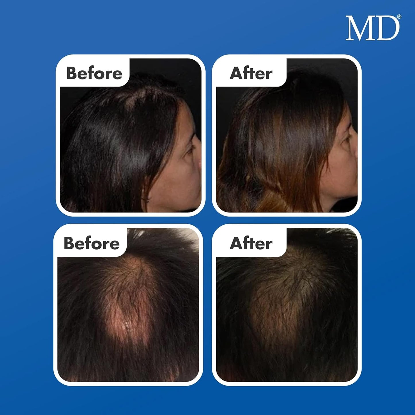 MD Factor suero natural para el crecimiento del cabello | Follicle Energizer Serum: evita el adelgazamiento del cabello y la pérdida de cabello al estimular los folículos capilares para producir un ca