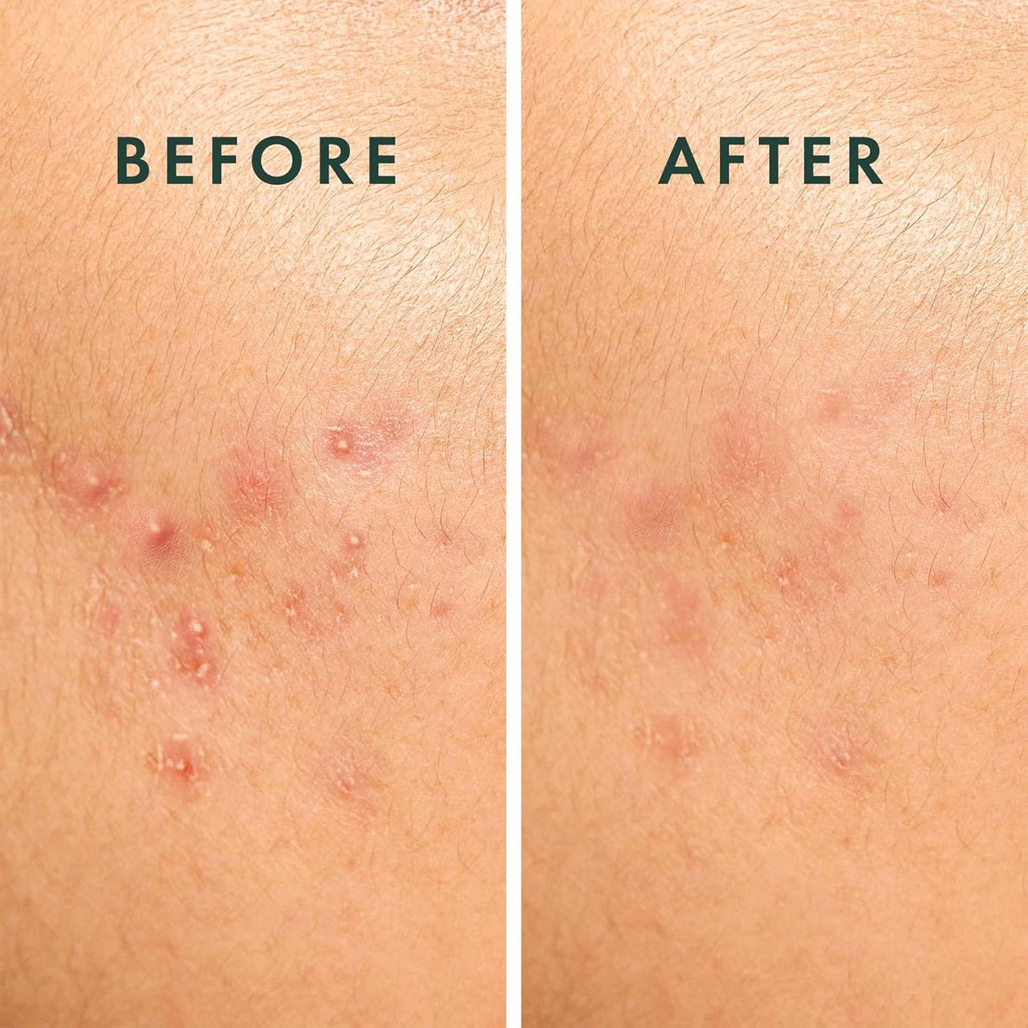 Rael Pimple Patches, Miracle Spot Control Cover - Hydrocolloid Acne Patch, Strips for Zits and Blemish, Korean Skin Care, Vegan, Cruelty Free (20 Count)