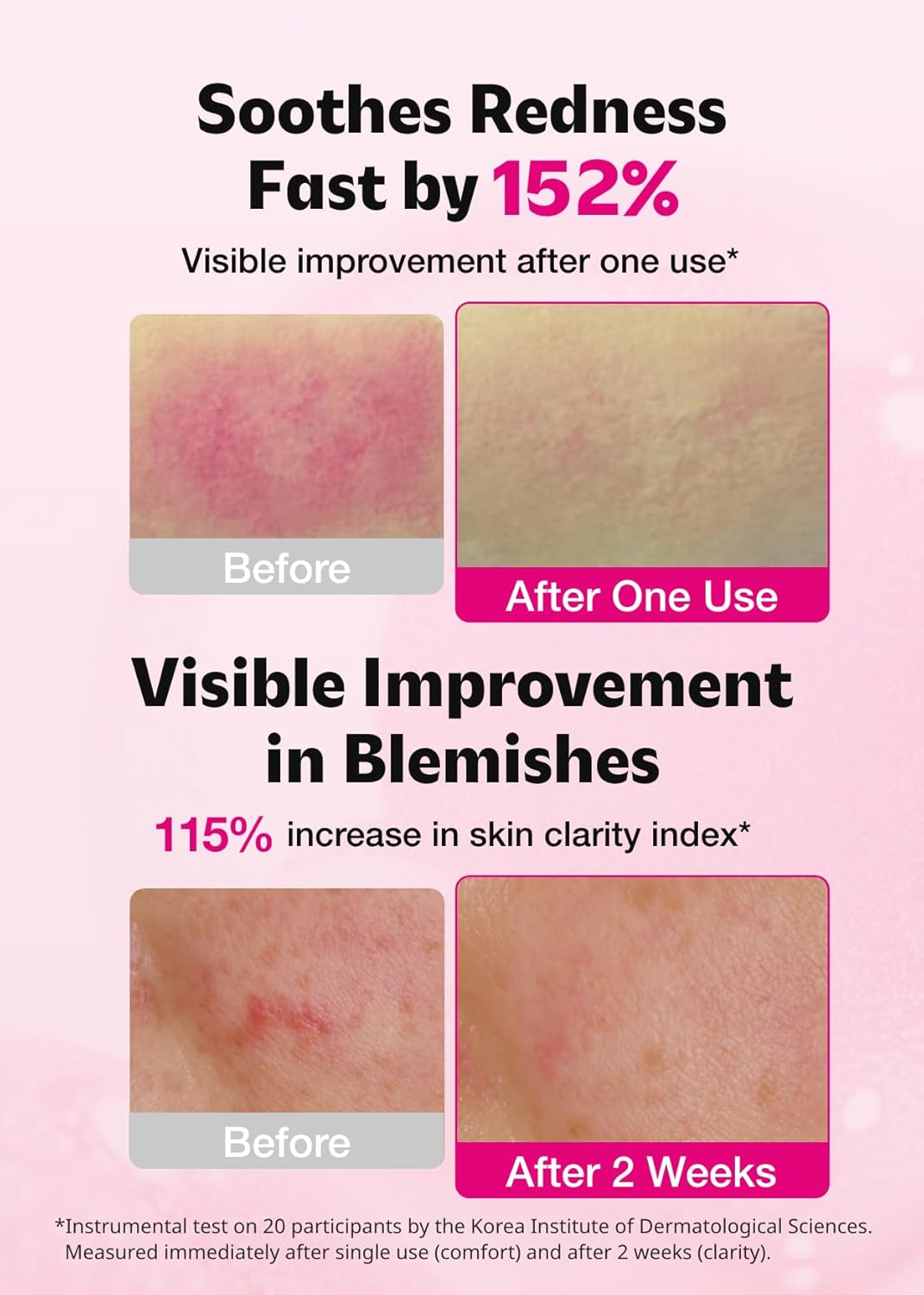 ISOI Blemish Care Up Serum for Face, Vegan Hydrating Serum for Smooth & Glass Skin Effect, Skin Barrier & Moisture Balance for Women, Arbutin, Korean Skin Care (1.18 fl. oz, 35ml)