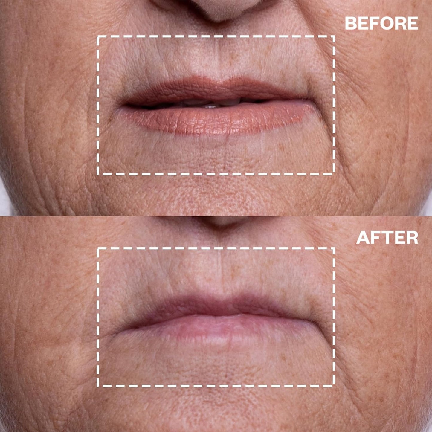 Wrinkles Schminkles Mouth & Lip Wrinkle Patch, 1-Pack, Reusable Hypoallergenic Silicone Smoothing Pads for Lip Wrinkle Prevention